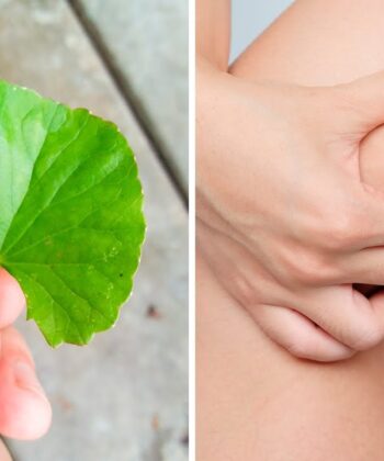 Ayurvedic Remedies for Varicose Veins: 4 Natural Ways to Heal Varicose Veins